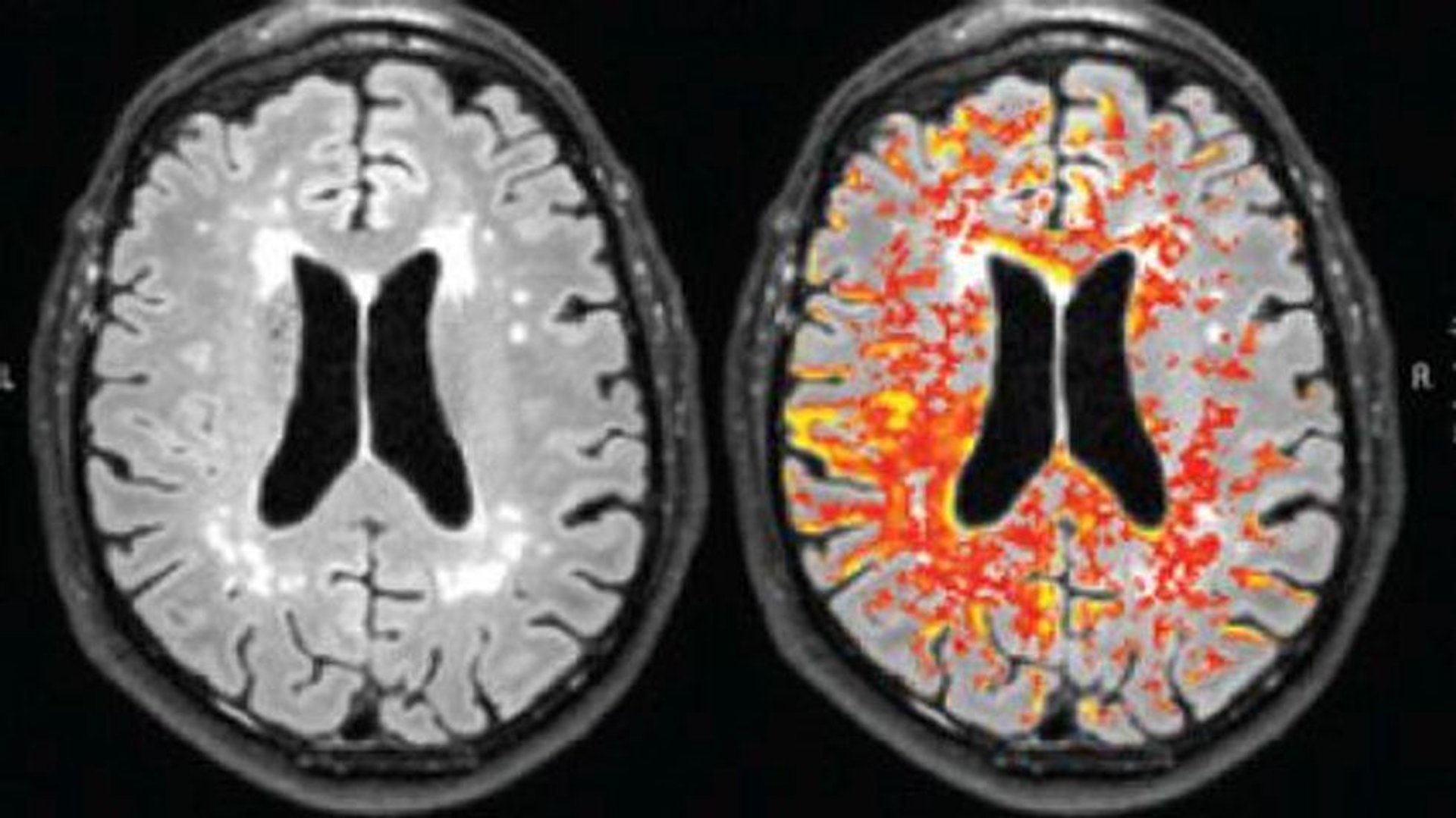 News Picture: Having OCD May Triple a Person's Odds for a Stroke